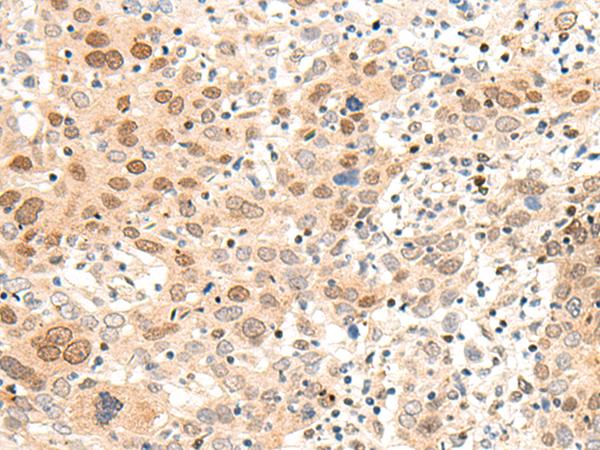 ARMC8 Antibody - Immunohistochemistry of paraffin-embedded Human cervical cancer tissue  using ARMC8 Polyclonal Antibody at dilution of 1:60(×200)