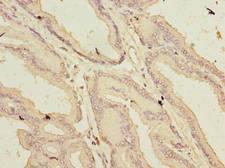 ARMCX1 Antibody - Immunohistochemistry of paraffin-embedded human prostate cancer using antibody at dilution of 1:100.