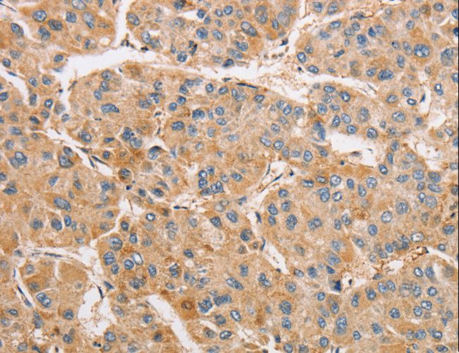 ARMCX1 Antibody - Immunohistochemistry of paraffin-embedded Human liver cancer using ARMCX1 Polyclonal Antibody at dilution of 1:40.