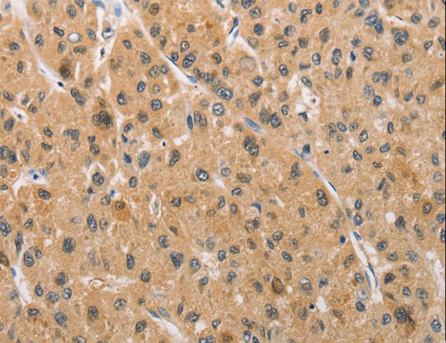 ARMCX1 Antibody - Immunohistochemistry of paraffin-embedded Human thyroid cancer using ARMCX1 Polyclonal Antibody at dilution of 1:40.