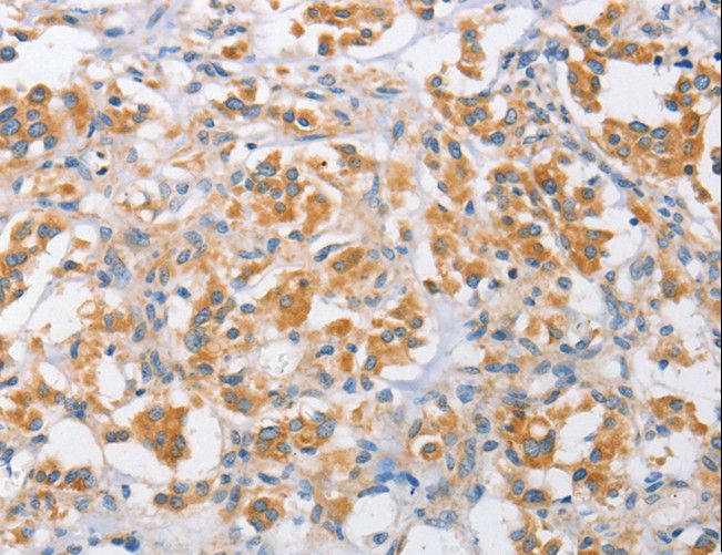 ARMCX1 Antibody - Immunohistochemistry of paraffin-embedded Human thyroid cancer using ARMCX1 Polyclonal Antibody at dilution of 1:40.