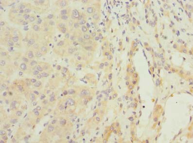 ARMCX2 Antibody - Immunohistochemistry of paraffin-embedded human liver cancer using antibody at dilution of 1:100.