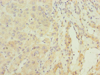 ARMCX2 Antibody - Immunohistochemistry of paraffin-embedded human liver cancer using ARMCX2 Antibody at dilution of 1:100