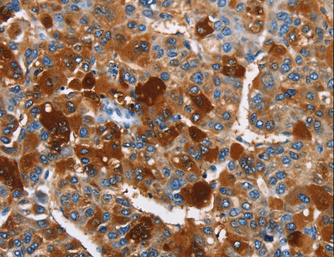 ARMCX2 Antibody - Immunohistochemistry of paraffin-embedded Human liver cancer using ARMCX2 Polyclonal Antibody at dilution of 1:40.
