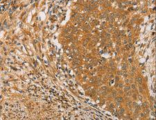ARMCX3 Antibody - Immunohistochemistry of paraffin-embedded Human thyroid cancer using ARMCX3 Polyclonal Antibody at dilution of 1:40.