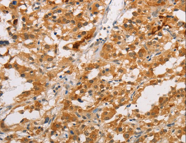 ARMCX3 Antibody - Immunohistochemistry of paraffin-embedded Human thyroid cancer using ARMCX3 Polyclonal Antibody at dilution of 1:40.