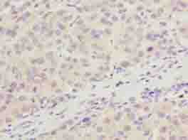 ARMT1 Antibody - Immunohistochemistry of paraffin-embedded human liver cancer using antibody at dilution of 1:100.