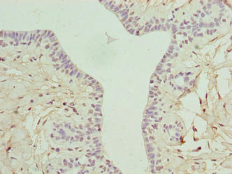 ARMT1 Antibody - Immunohistochemistry of paraffin-embedded human breast cancer using ARMT1 Antibody at dilution of 1:100