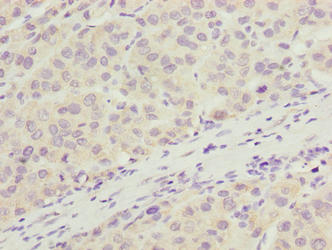 ARMT1 Antibody - Immunohistochemistry of paraffin-embedded human liver cancer using ARMT1 Antibody at dilution of 1:100