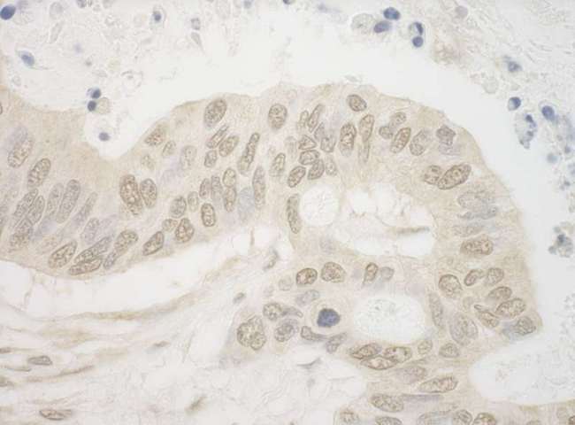 ARNT / HIF-1-Beta Antibody - Detection of Human ARNT by Immunohistochemistry. Sample: FFPE section of human ovarian carcinoma. Antibody: Affinity purified rabbit anti-ARNT used at a dilution of 1:1000 (1 Detection: DAB.