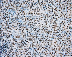 ARNT / HIF-1-Beta Antibody - IHC of paraffin-embedded Carcinoma of Human thyroid tissue using anti-ARNT mouse monoclonal antibody.
