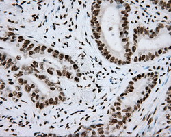 ARNT / HIF-1-Beta Antibody - IHC of paraffin-embedded Adenocarcinoma of Human colon tissue using anti-ARNT mouse monoclonal antibody.