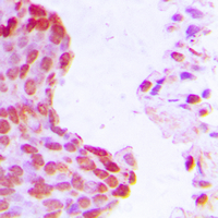 ARNT / HIF-1-Beta Antibody - Immunohistochemical analysis of HIF1 beta staining in human breast cancer formalin fixed paraffin embedded tissue section. The section was pre-treated using heat mediated antigen retrieval with sodium citrate buffer (pH 6.0). The section was then incubated with the antibody at room temperature and detected using an HRP-conjugated compact polymer system. DAB was used as the chromogen. The section was then counterstained with hematoxylin and mounted with DPX.