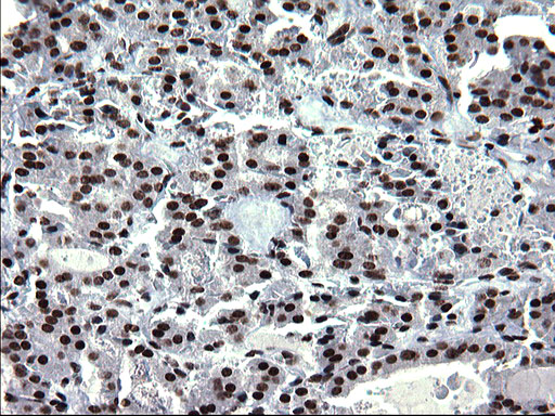 ARNTL / BMAL1 Antibody - IHC of paraffin-embedded Carcinoma of Human thyroid tissue using anti-ARNTL mouse monoclonal antibody. (Heat-induced epitope retrieval by 1 mM EDTA in 10mM Tris, pH8.5, 120°C for 3min).