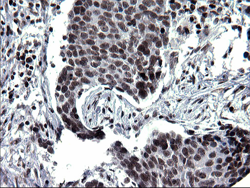 ARNTL / BMAL1 Antibody - IHC of paraffin-embedded Carcinoma of Human lung tissue using anti-ARNTL mouse monoclonal antibody. (Heat-induced epitope retrieval by 1 mM EDTA in 10mM Tris, pH8.5, 120°C for 3min).