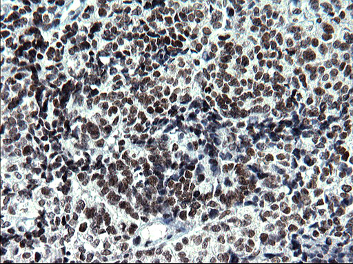 ARNTL / BMAL1 Antibody - IHC of paraffin-embedded Adenocarcinoma of Human endometrium tissue using anti-ARNTL mouse monoclonal antibody. (Heat-induced epitope retrieval by 1 mM EDTA in 10mM Tris, pH8.5, 120°C for 3min).