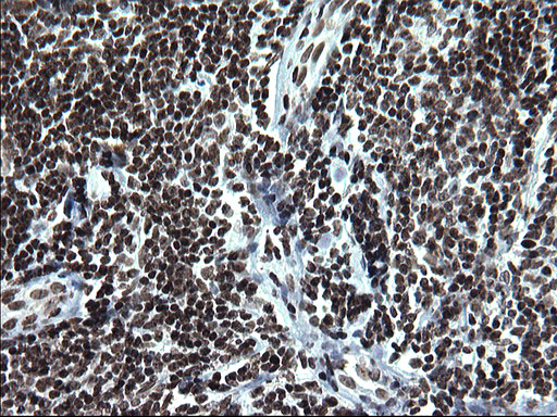 ARNTL / BMAL1 Antibody - IHC of paraffin-embedded Human lymphoma tissue using anti-ARNTL mouse monoclonal antibody. (Heat-induced epitope retrieval by 1 mM EDTA in 10mM Tris, pH8.5, 120°C for 3min).
