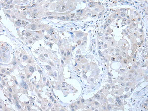 ARP5 / ANGPTL6 Antibody - Immunohistochemistry of paraffin-embedded Human esophagus cancer tissue  using ANGPTL6 Polyclonal Antibody at dilution of 1:55(×200)