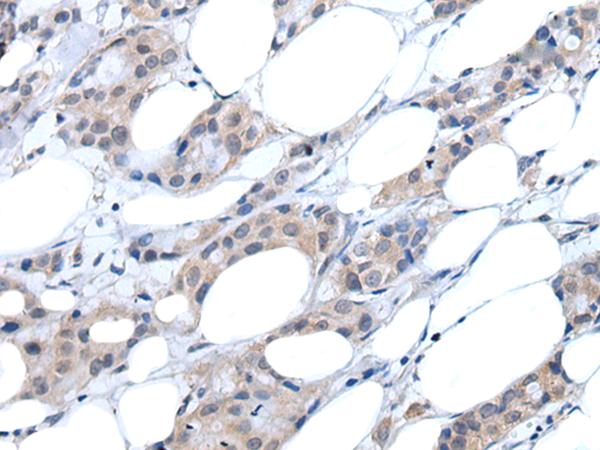 ARP5 / ANGPTL6 Antibody - Immunohistochemistry of paraffin-embedded Human breast cancer tissue  using ANGPTL6 Polyclonal Antibody at dilution of 1:55(×200)