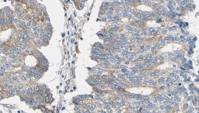 ARPC1A Antibody - 1:100 staining human prostate tissue by IHC-P. The sample was formaldehyde fixed and a heat mediated antigen retrieval step in citrate buffer was performed. The sample was then blocked and incubated with the antibody for 1.5 hours at 22°C. An HRP conjugated goat anti-rabbit antibody was used as the secondary.