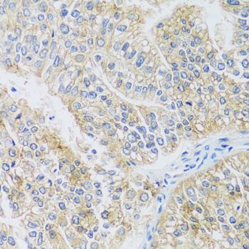 ARPC1A Antibody - Immunohistochemistry of paraffin-embedded Human uterine cancer using ARPC1A Polyclonal Antibody at dilution of 1:100 (40x lens).