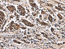 ARPC1B / p41-ARC / ARP2 Antibody - Immunohistochemistry of paraffin-embedded Human breast cancer tissue  using ARPC1B Polyclonal Antibody at dilution of 1:65(×200)