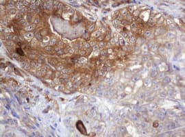 ARPC5 / p16-Arc Antibody - IHC of paraffin-embedded Adenocarcinoma of Human colon tissue using anti-ARPC5 mouse monoclonal antibody.