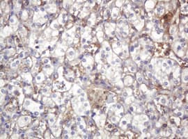 ARPC5 / p16-Arc Antibody - IHC of paraffin-embedded Carcinoma of Human kidney tissue using anti-ARPC5 mouse monoclonal antibody.