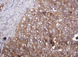 ARPC5 / p16-Arc Antibody - IHC of paraffin-embedded Adenocarcinoma of Human ovary tissue using anti-ARPC5 mouse monoclonal antibody.