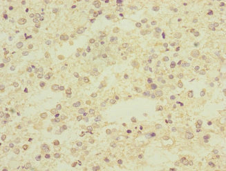 ARPC5 / p16-Arc Antibody - Immunohistochemistry of paraffin-embedded human glioma at dilution 1:100