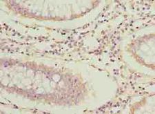 ARPIN / C15orf38 Antibody - Immunohistochemistry of paraffin-embedded human colon cancer using antibody at dilution of 1:100.