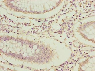 ARPIN / C15orf38 Antibody - Immunohistochemistry of paraffin-embedded human colon cancer using ARPIN Antibody at dilution of 1:100