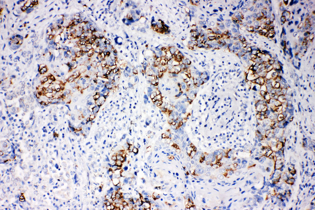 ARRB1 / Beta Arrestin 1 Antibody - ARRB1 / Beta Arrestin 1 antibody. IHC(P): Human Breast Cancer Tissue.