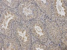 ARRB1 / Beta Arrestin 1 Antibody - Immunohistochemistry of paraffin-embedded human liver cancer using ARRB1 antibody at dilution of 1:100 (200x lens).