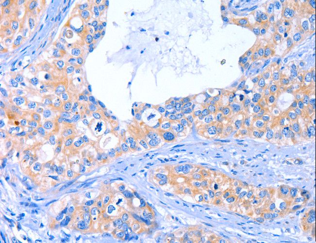 ARRB1 / Beta Arrestin 1 Antibody - Immunohistochemistry of paraffin-embedded Human cervical cancer using ARRB1 Polyclonal Antibody at dilution of 1:50.