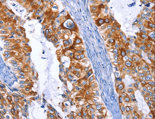 ARRB1 / Beta Arrestin 1 Antibody - Immunohistochemistry of paraffin-embedded Human colon cancer using ARRB1 Polyclonal Antibody at dilution of 1:50.