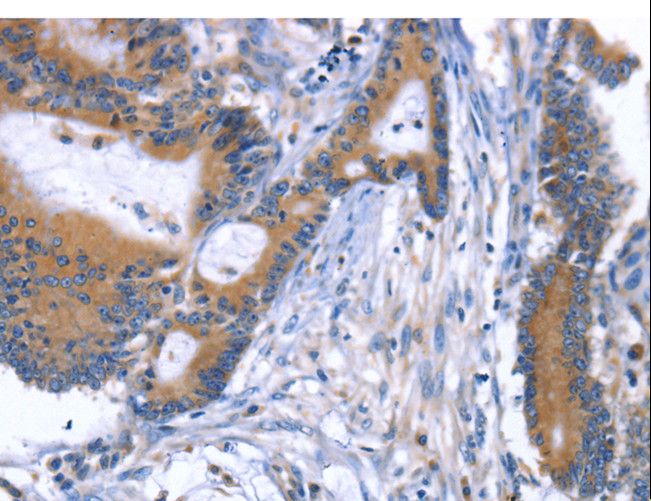 ARRB1 / Beta Arrestin 1 Antibody - Immunohistochemistry of paraffin-embedded Human colon cancer using ARRB1 Polyclonal Antibody at dilution of 1:50.