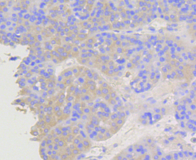 ARRB1 / Beta Arrestin 1 Antibody - Immunohistochemistry of paraffin-embedded human liver cancer using ARRB1 antibodyat dilution of 1:100 (40x lens).
