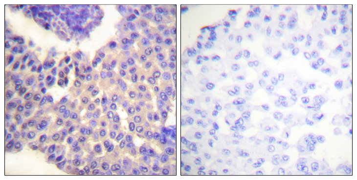ARRB1 / Beta Arrestin 1 Antibody - Immunohistochemistry analysis of paraffin-embedded human breast carcinoma, using Arrestin 1 (Phospho-Ser412) Antibody. The picture on the right is blocked with the phospho peptide.