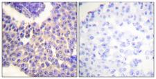 ARRB1 / Beta Arrestin 1 Antibody - Immunohistochemistry analysis of paraffin-embedded human breast carcinoma, using Arrestin 1 (Phospho-Ser412) Antibody. The picture on the right is blocked with the phospho peptide.