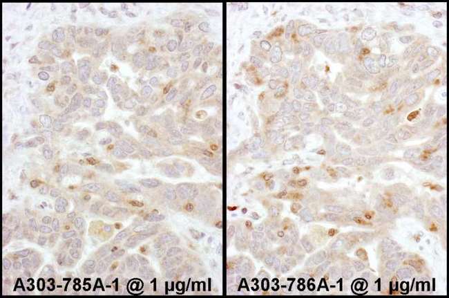 ARRB2 / Beta Arrestin 2 Antibody - Detection of Human Beta-Arrestin 2 by Immunohistochemistry. Samples: FFPE sections of human ovarian carcinoma. Antibody: Affinity purified rabbit anti-Beta-Arrestin 2 used at a dilution of 1:1000 (1 ug/ml) (left). Detection: DAB.