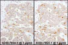 ARRB2 / Beta Arrestin 2 Antibody - Detection of Human Beta-Arrestin 2 by Immunohistochemistry. Samples: FFPE sections of human ovarian carcinoma. Antibody: Affinity purified rabbit anti-Beta-Arrestin 2 used at a dilution of 1:1000. Detection: DAB.