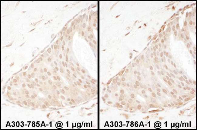 ARRB2 / Beta Arrestin 2 Antibody - Detection of Human Beta-Arrestin 2 by Immunohistochemistry. Samples: FFPE sections of human breast carcinoma. Antibody: Affinity purified rabbit anti-Beta-Arrestin 2used at a dilution of 1:1000 (1 ug/ml) (right). Detection: DAB.