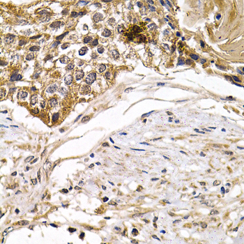 ARRB2 / Beta Arrestin 2 Antibody - Immunohistochemistry of paraffin-embedded human breast cancer tissue.