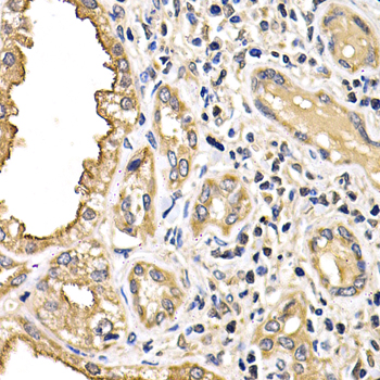 ARRB2 / Beta Arrestin 2 Antibody - Immunohistochemistry of paraffin-embedded human kidney cancer tissue.