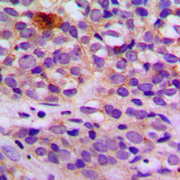 ARRDC4 Antibody - Immunohistochemical analysis of ARRDC4 staining in human breast cancer formalin fixed paraffin embedded tissue section. The section was pre-treated using heat mediated antigen retrieval with sodium citrate buffer (pH 6.0). The section was then incubated with the antibody at room temperature and detected using an HRP conjugated compact polymer system. DAB was used as the chromogen. The section was then counterstained with hematoxylin and mounted with DPX. w