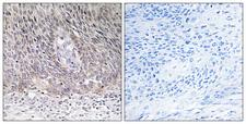 ARSA / Arylsulfatase A Antibody - Immunohistochemistry analysis of paraffin-embedded human cervix carcinoma tissue, using ARSA Antibody. The picture on the right is blocked with the synthesized peptide.