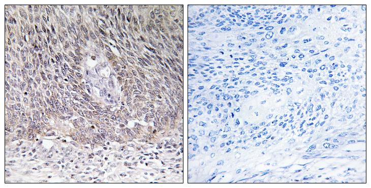 ARSA / Arylsulfatase A Antibody - Peptide - + Immunohistochemistry analysis of paraffin-embedded human cervix carcinoma tissue using ARSA antibody.