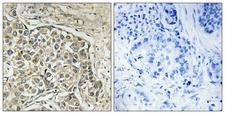 ARSD / Arylsulfatase D Antibody - Immunohistochemistry analysis of paraffin-embedded human lung carcinoma tissue, using ARSD Antibody. The picture on the right is blocked with the synthesized peptide.