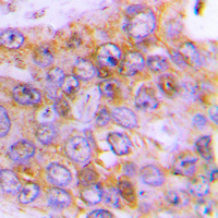 ARSD / Arylsulfatase D Antibody - Immunohistochemical analysis of Arylsulfatase D staining in human lung cancer formalin fixed paraffin embedded tissue section. The section was pre-treated using heat mediated antigen retrieval with sodium citrate buffer (pH 6.0). The section was then incubated with the antibody at room temperature and detected using an HRP conjugated compact polymer system. DAB was used as the chromogen. The section was then counterstained with hematoxylin and mounted with DPX.